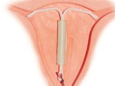 生过孩子后上环,生完小孩上环后要注意哪些