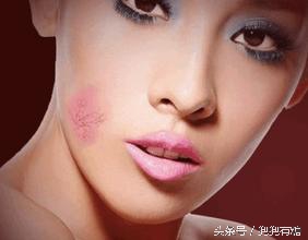 *血丝红**怎么保养？*血丝红**的形成、治疗偏方与保养