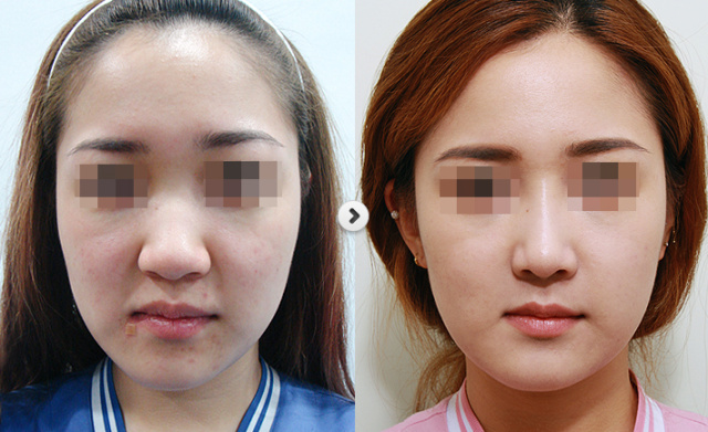 鼻子不好看能改善吗,大鼻子不好看怎么办