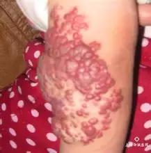 白色胎记的图片,胎记知多少基础篇