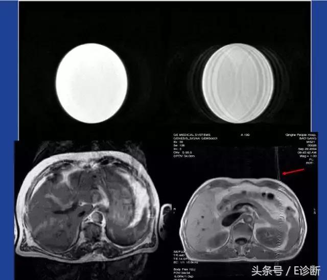 磁共振伪影及解决方案,e系列诊断