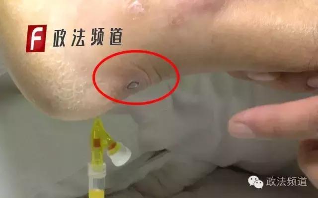 男子骑摩托被蜜蜂蜇,男子被马蜂蜇伤民警紧急救助