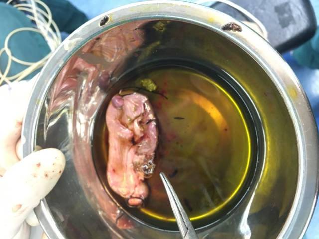 胆囊里面有虫怎么办,胆囊有虫什么症状