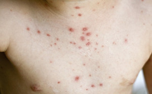 “*品毒**”引起的皮肤病变，触目惊心！