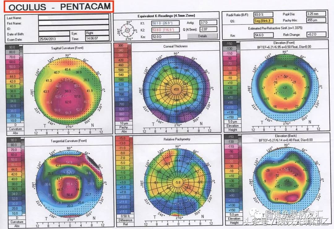 角膜地形图诊断标准,角膜地形图能确诊圆锥角膜