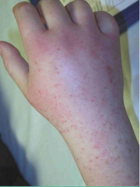 过敏性紫癜算是风湿病的一种吗,风湿性关节炎与过敏性紫癜区别