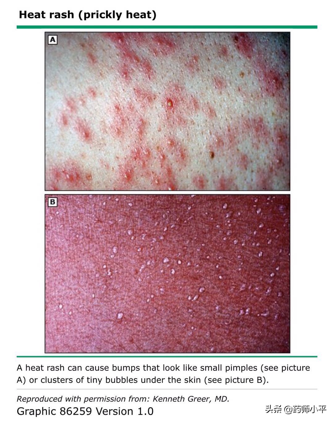 小孩长痱子擦了炉甘石皮肤变色了,孩子长痱子可以用炉甘石洗剂