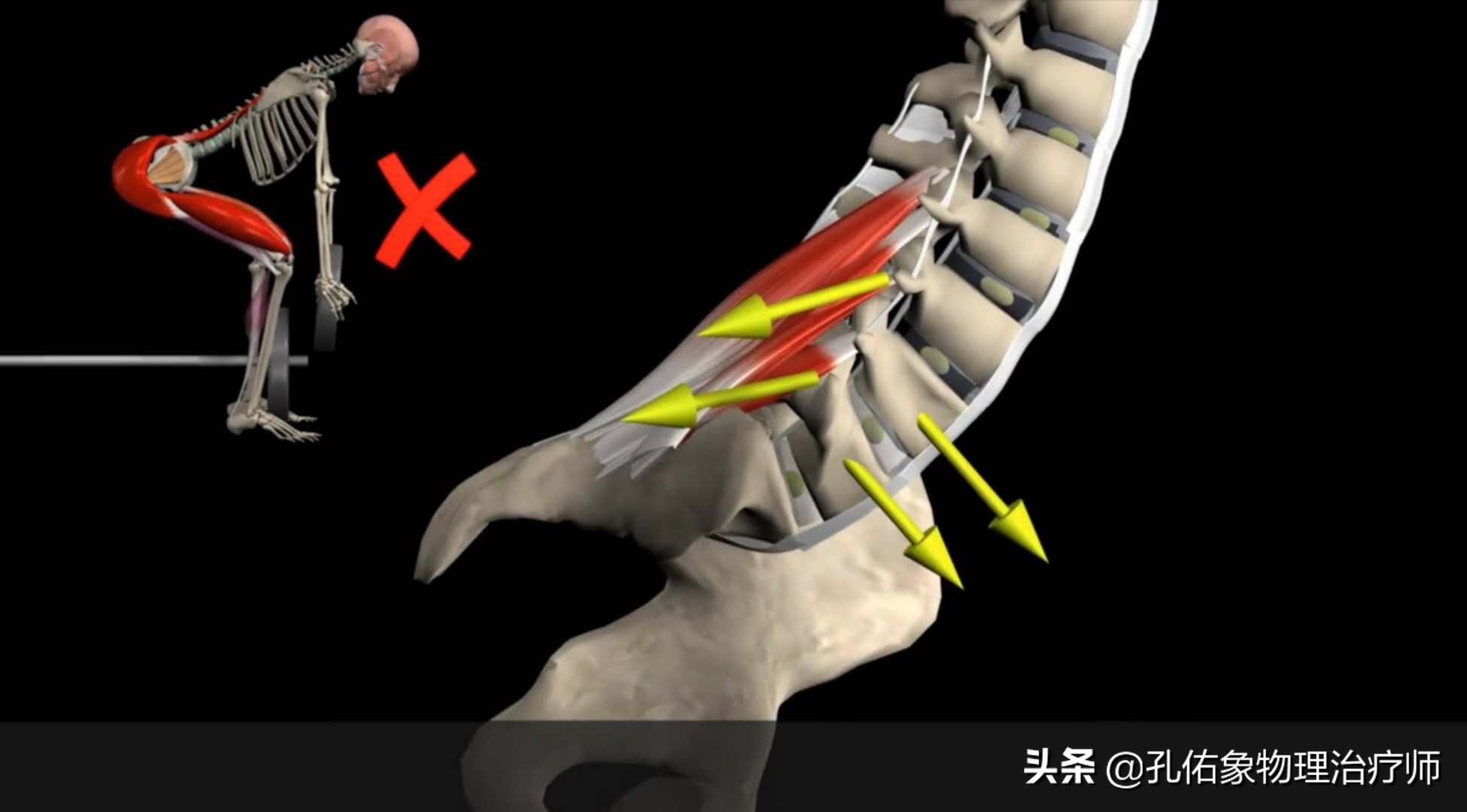 腰肌劳损反复发作，治疗很困惑，一文给您详细讲清楚如何正确治疗