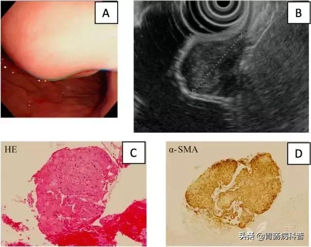 胃窦粘膜下隆起病变是胃癌吗,胃镜报告胃窦伴有隆起