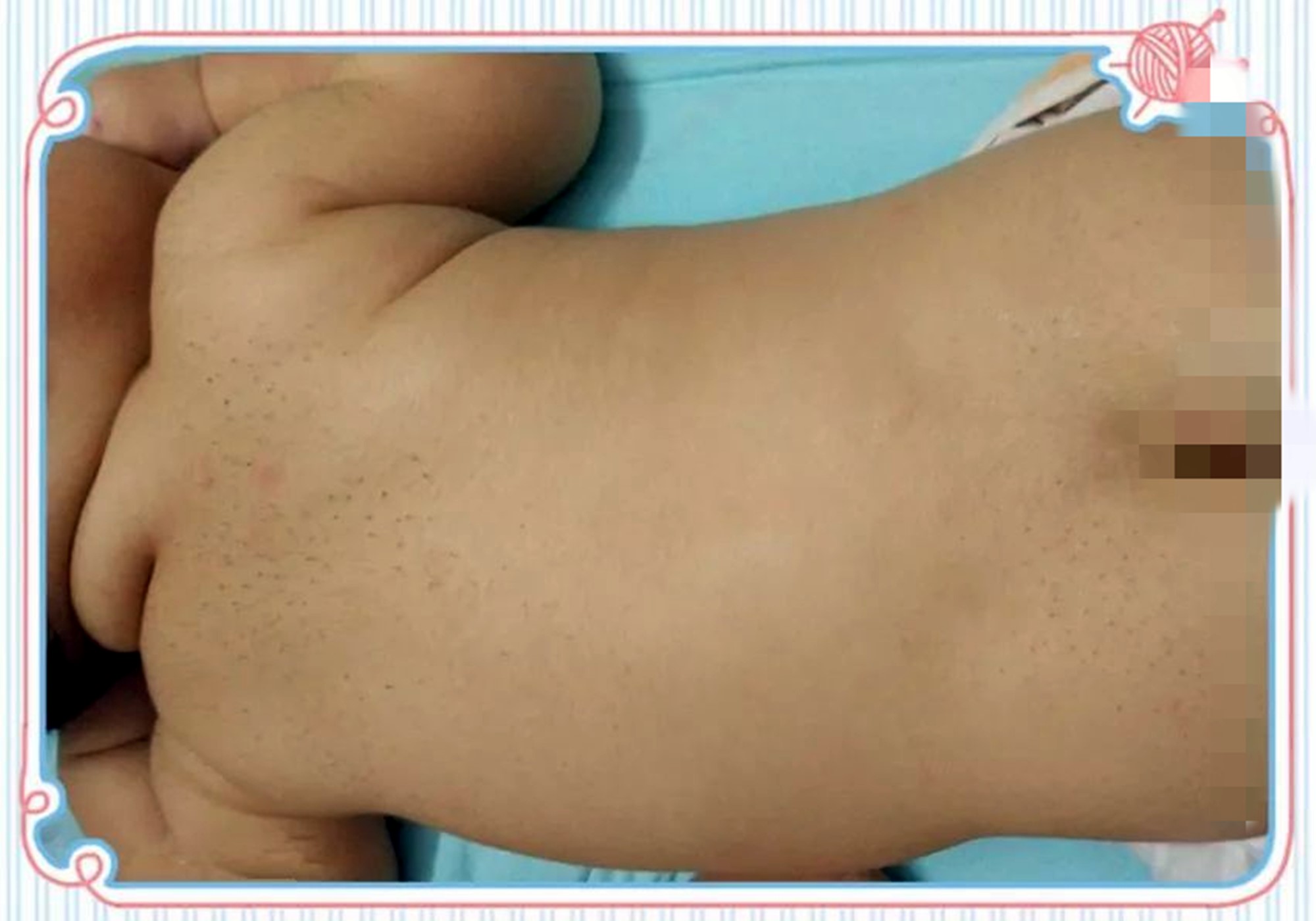 宝宝身上长有小黑刺怎么办,新生儿背部长黑刺怎么治