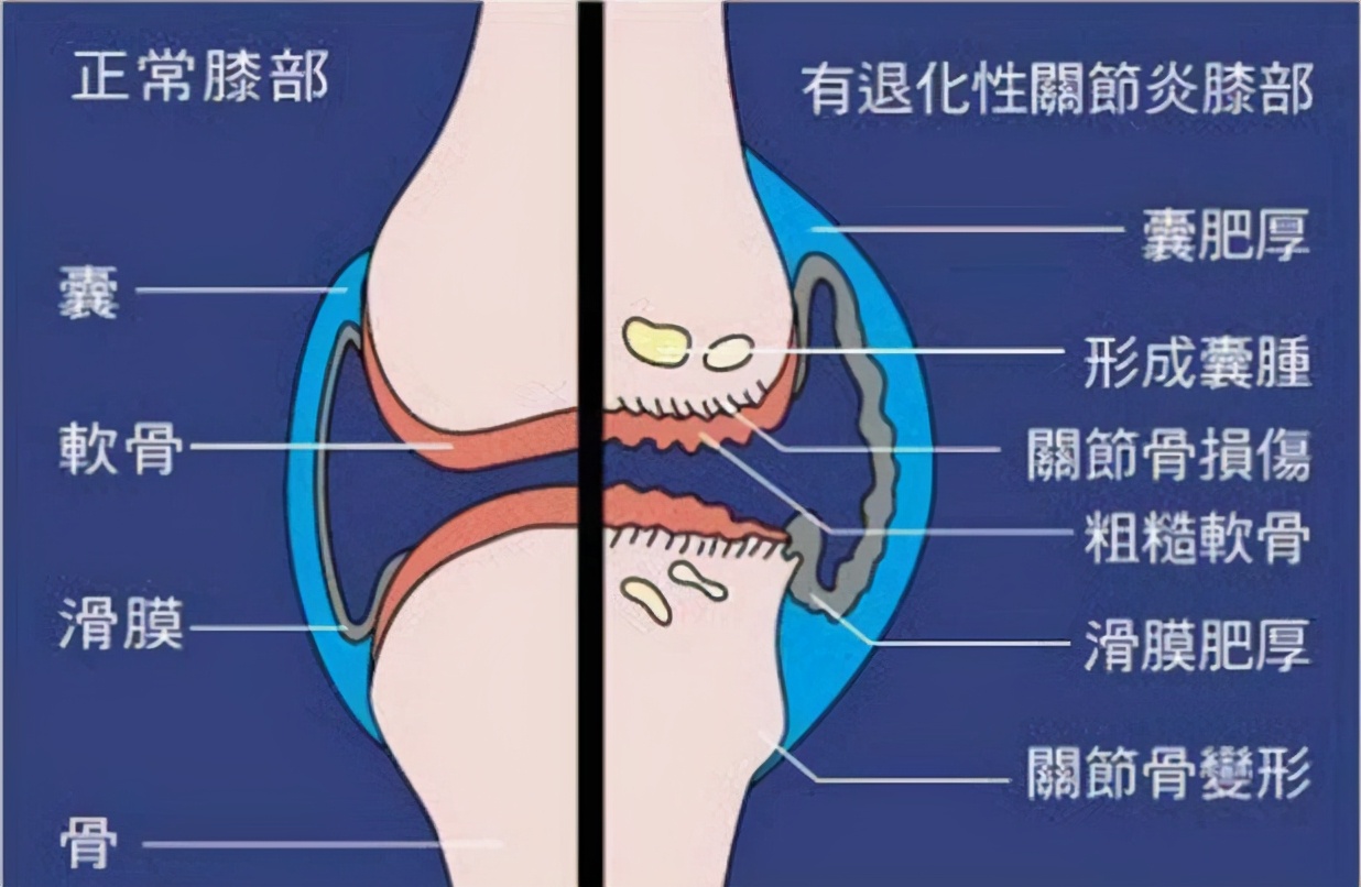 骨关节炎怎样保养与治疗,骨关节炎防治偏方