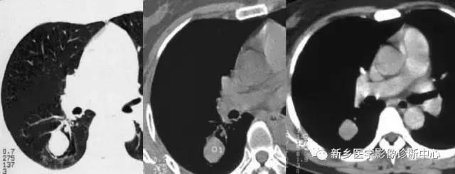 肺部有球形病灶怎么治疗,肺内多发结节诊断早期肺癌怎么办