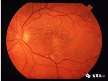 年龄相关性黄斑变性辅助检查,年龄相关性黄斑变性