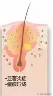 疮可以用针挑掉吗,痘疮净可以祛痘吗