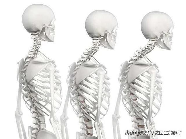 颈椎病和肥胖有关系么,脖子后面有堆肉是颈椎出问题了吗