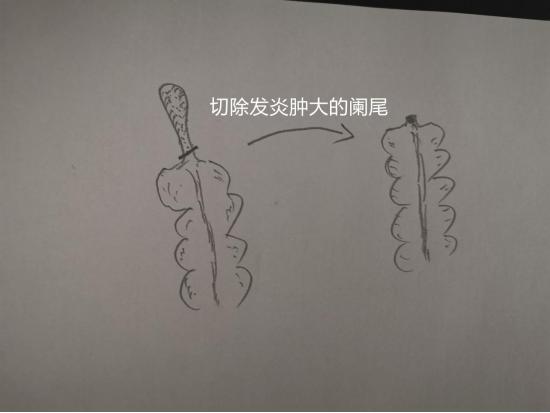 热血外科|Dr.Liu聊科普:阑尾炎究竟是何方妖孽？