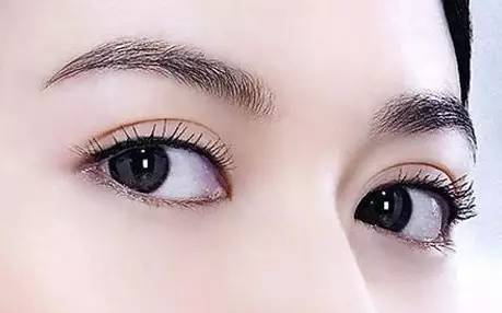 双眼皮手术睁眼闭眼效果,双眼皮手术怎么看着不假