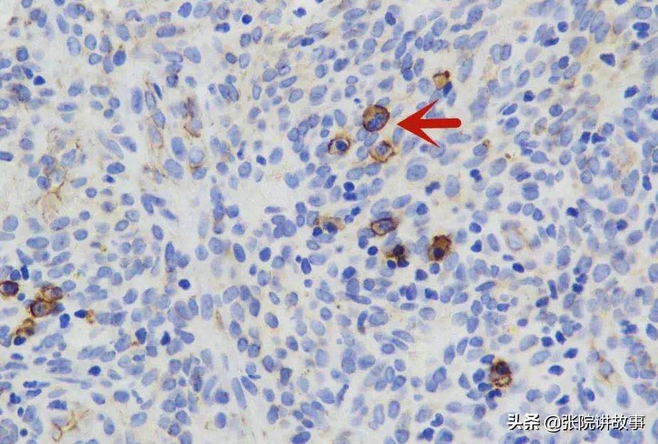 「张院讲故事」子宫内膜炎是如何导致女性不孕的?