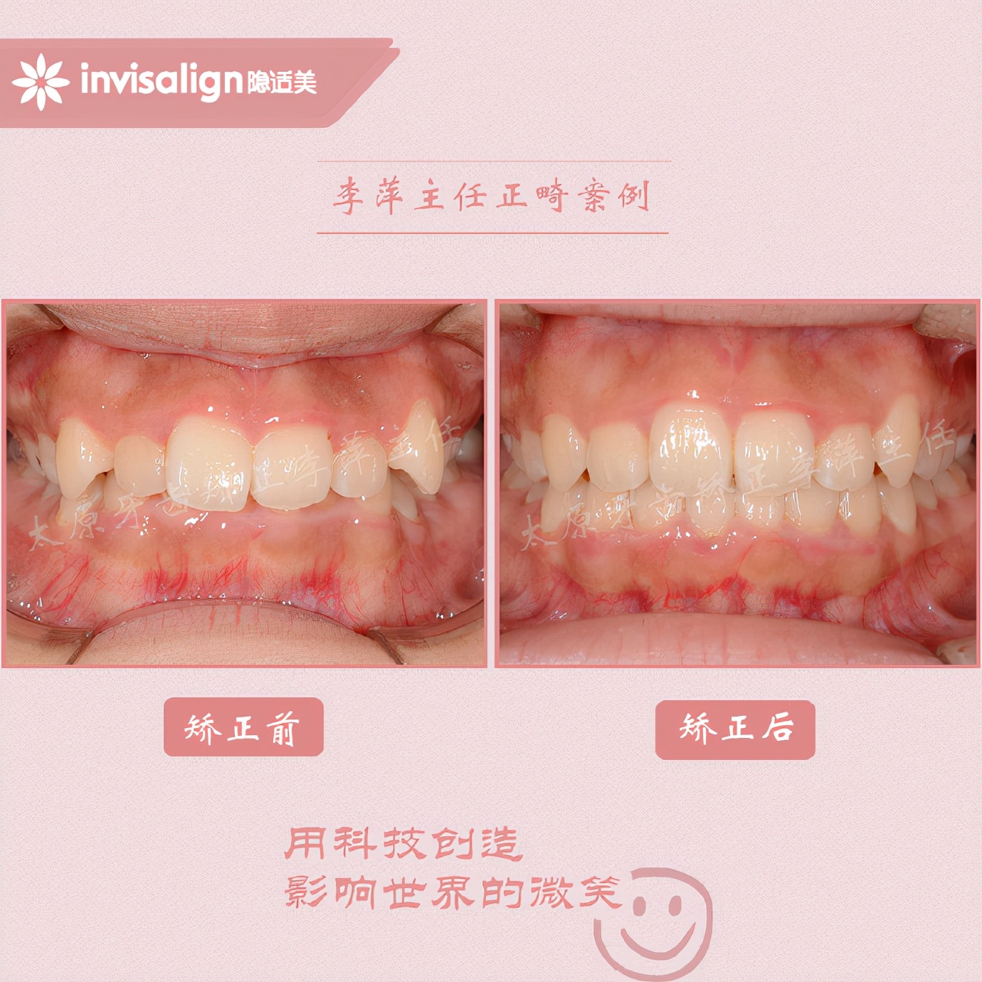 太原牙齿隐形矫正,太原牙齿正畸贵吗