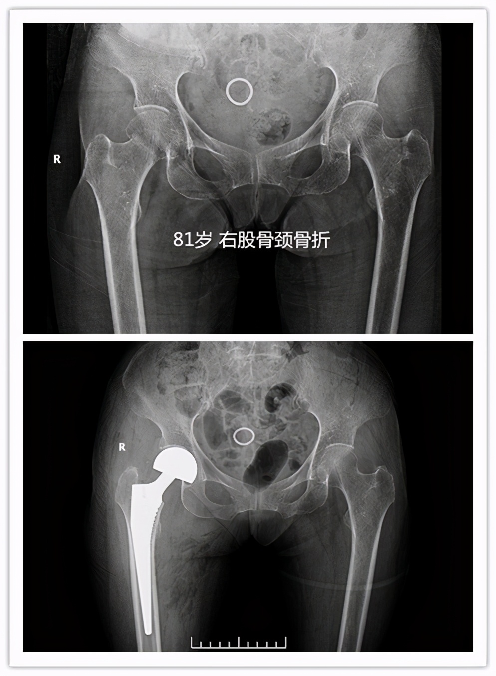 人生最后一次骨折有必要手术吗,人生的最后一次骨折指哪个部位