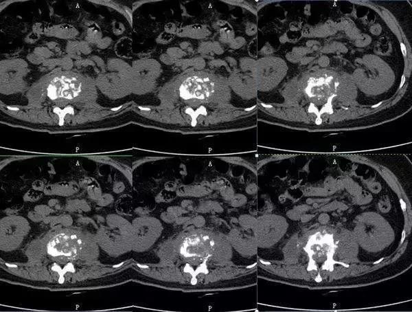 脊柱结核是怎么回事,健康科普不该被忽视的脊柱结核