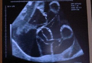 孕妇水肿消除的最好方法是,孕妇水肿要怎么缓解