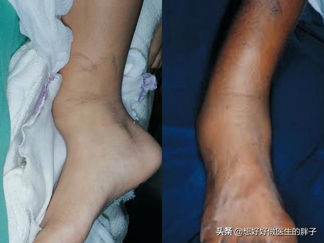 踝关节扭伤注意事项有哪些,踝关节轻微扭伤也会再次扭伤吗