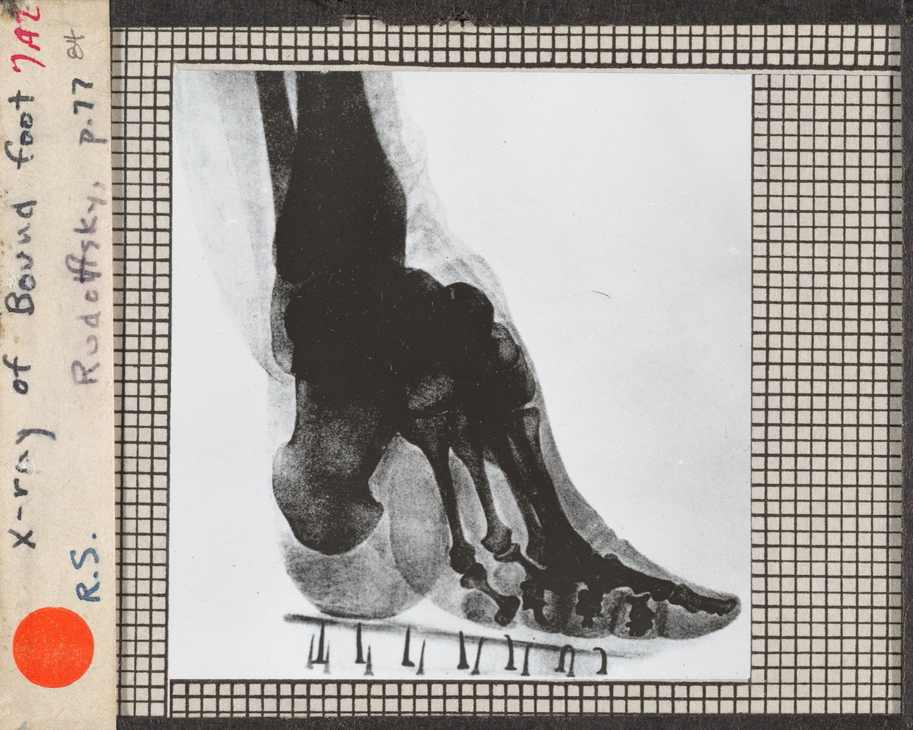实拍三寸金莲裹脚缠足全过程,三寸金莲的详细缠足过程