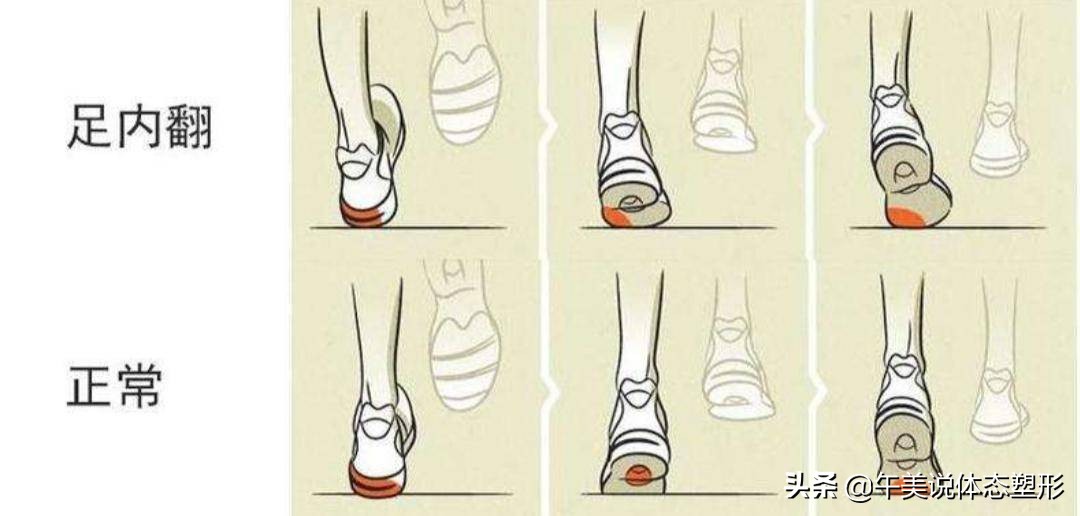 膝盖下o型腿怎么矫正,膝盖腿弯疼最好治疗方法