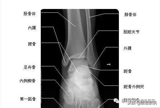 踝关节术后康复理疗,踝关节术后康复拉筋