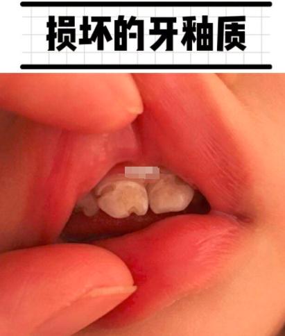 名医访｜4招教你保护牙釉质！从这件小事做起！