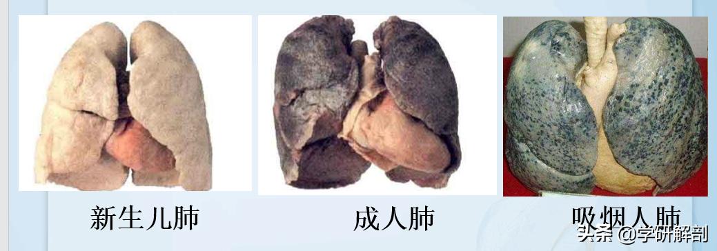 感染新冠的肺解剖图,第一例新冠肺炎解剖病例