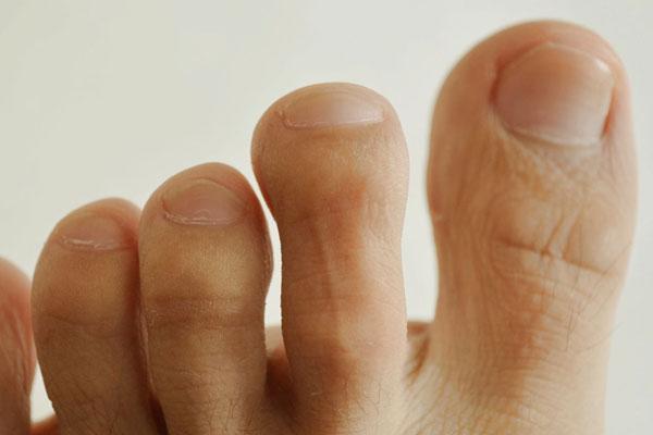 脚指甲长肉里一碰就疼用什么工具,脚指甲两边长进肉里好疼怎么办