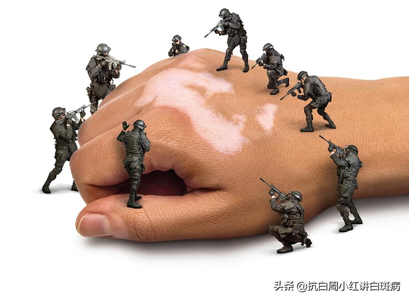 白癜风的白斑一般的症状是什么呢,白癜风的白斑一般的症状是什么