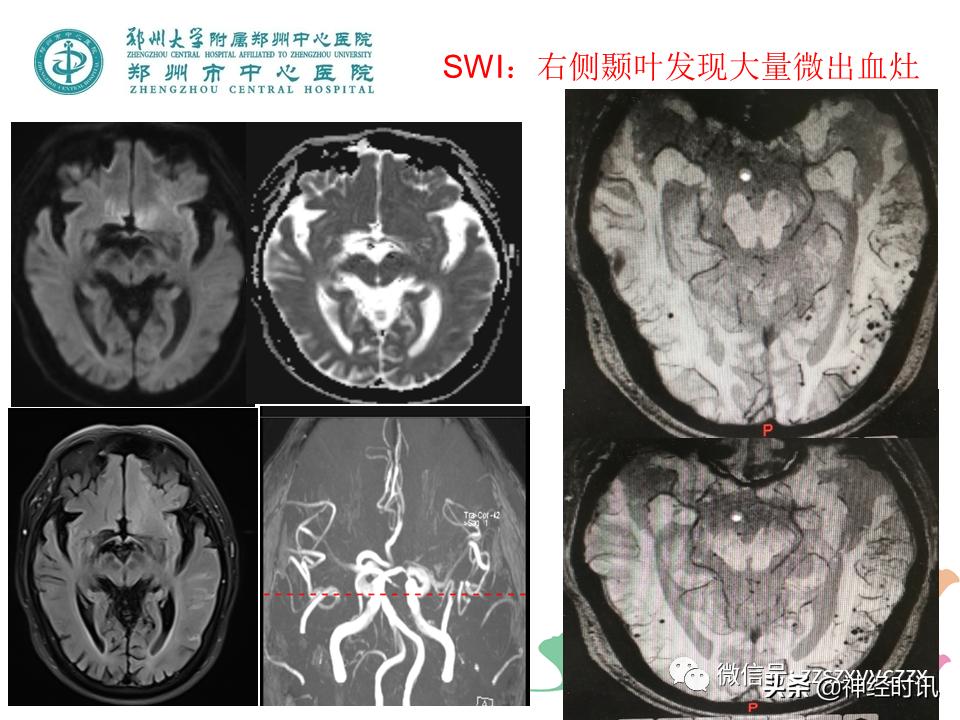 静脉溶栓怎么引起的,静脉相关并发症的预防及处理