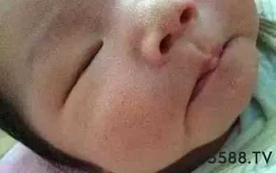 脂肪粒和汗管瘤扁平疣的区别,扁平疣和汗管瘤脂肪粒鉴别办法