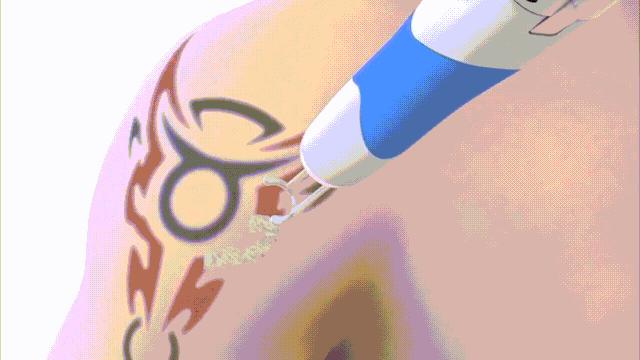 超皮秒避坑,超皮秒祛斑适合角质层薄的人