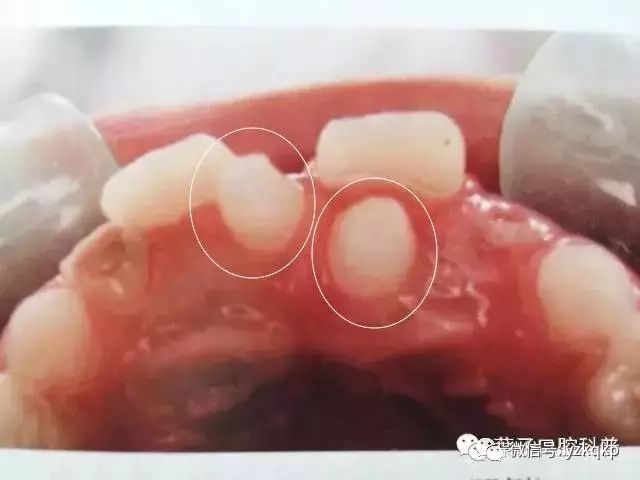 4岁小孩儿牙缝大正常吗,小朋友牙缝大正常吗