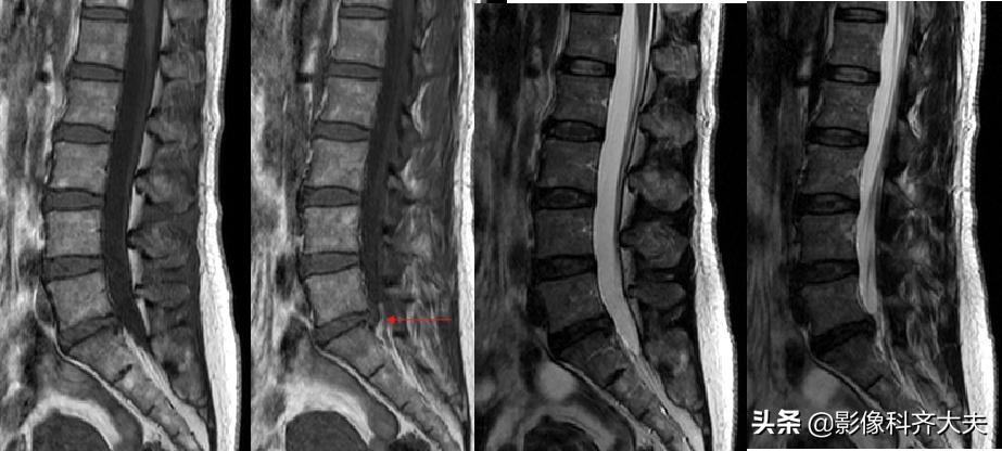 腰椎间盘突出最好的影像诊断方法,腰椎间盘突出的影像学检查