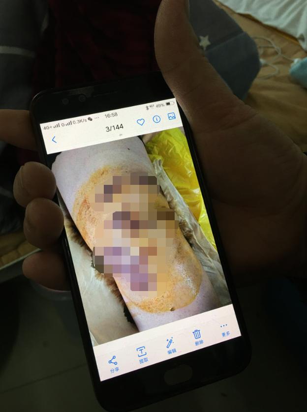 河南杞县115人针灸后针眼溃烂：针灸前被注射药物，事发后仍有人苦求继续针灸，患者需手术切开伤口排脓