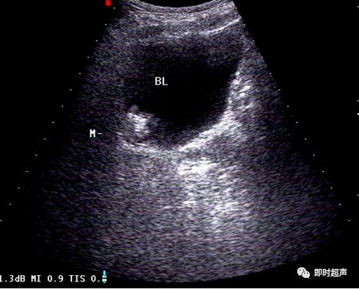 膀胱超声图解大全,膀胱超声解剖及常见病变超声表现