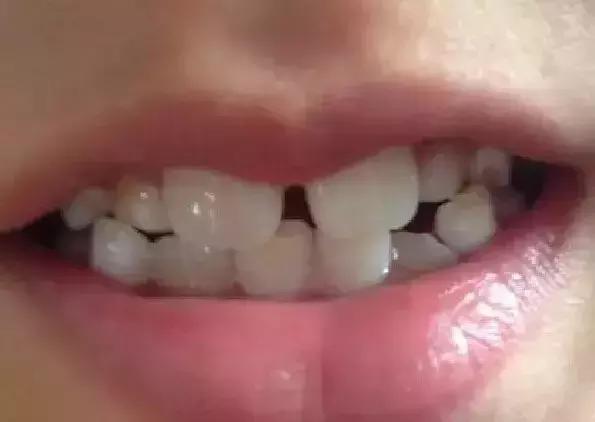 孩子新换的牙成锯齿状是什么原因,孩子新换的门牙是凹的正常吗
