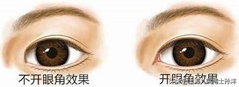 开眼角不对称可以免费修复吗,做开眼角后用什么祛疤
