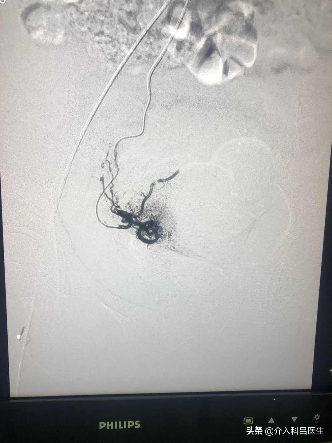 子宫腺肌瘤扎针效果好不好,子宫腺肌症巧囊手术