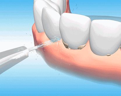 牙齿松了怎么治疗最好,牙齿松了怎么办教你如何快速恢复
