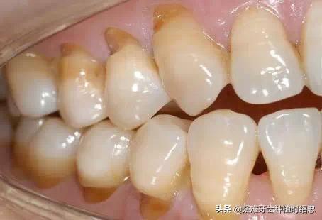 改变刷牙方式楔状缺损就会停止吗,刷牙导致楔状缺损牙齿会断么