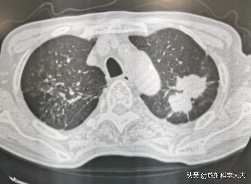 几年前得过肺结核现在胸透有阴影,结核治疗一年了还有胸痛