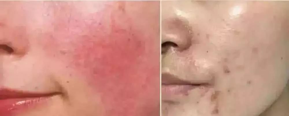 拯救痘痘烂脸用什么药,拯救痘痘烂脸这个小窍门你知道吗