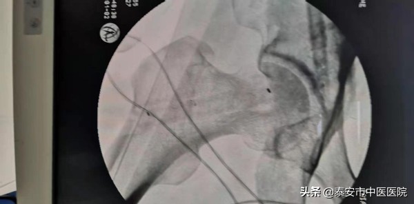 坏死的股骨头还能保得住吗？——*安泰**市中医医院脊柱外科助力患者进行股骨头坏死保髋治疗
