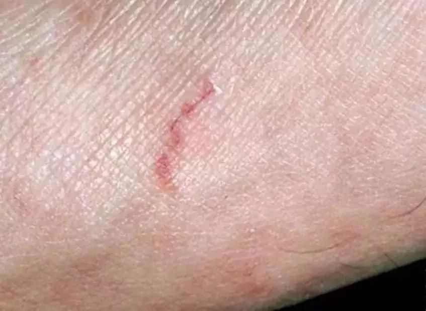 螨虫叮咬传播疾病,尘螨叮咬怎么治疗